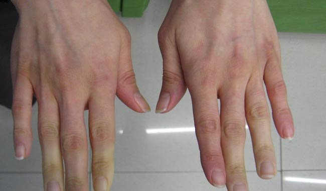 La sindrome di Sjogren che cosa fare